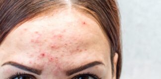 Acne Treatment Clinic, Prachinburi